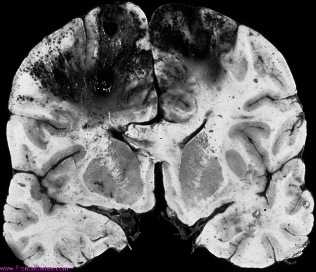 Bilateral venous infarcts secondary to superior sagittal sinus thrombosis